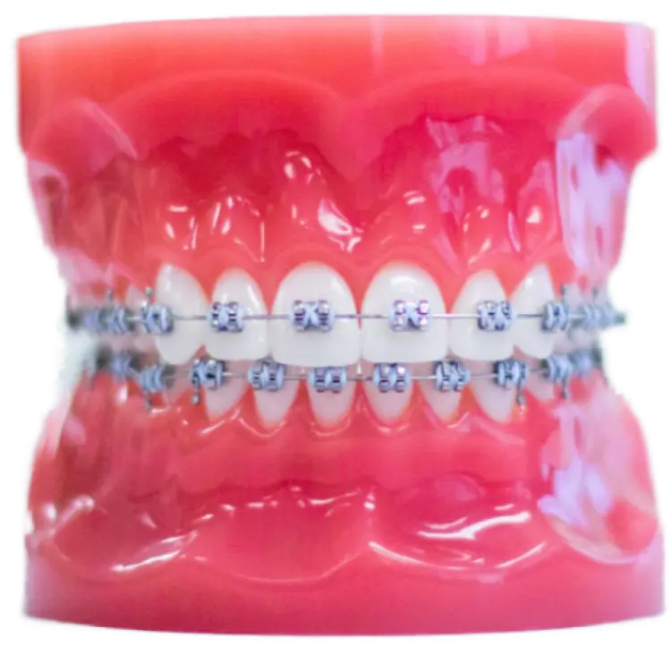 Windy City Orthodontics metal braces